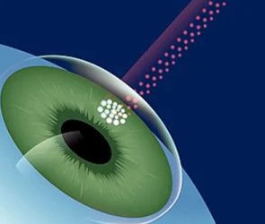 LASIK Surgery